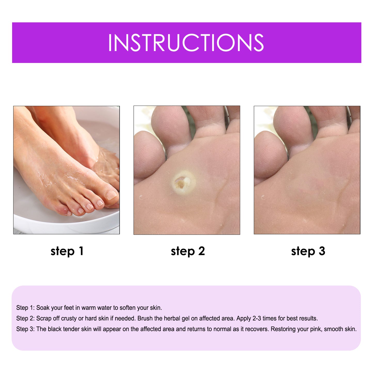 Fifuroes Remove Chicken Eye Lotion Extra Clear Remove Corns Skin Care Chicken Calluses Foot Pad Gram Warts