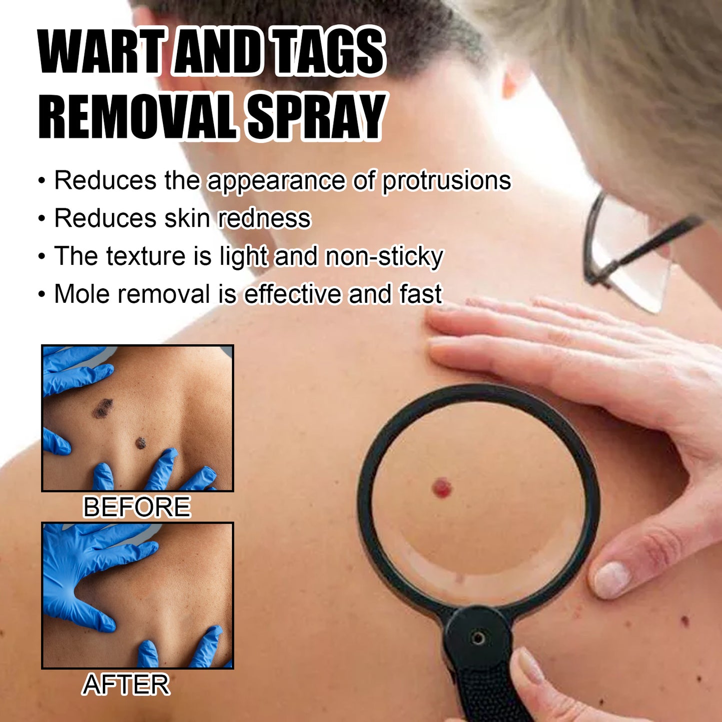 Fifuroes Wart And Tags Removal Spray, Cleanse And Fade Body Moles Smooth Skin Repair Spray