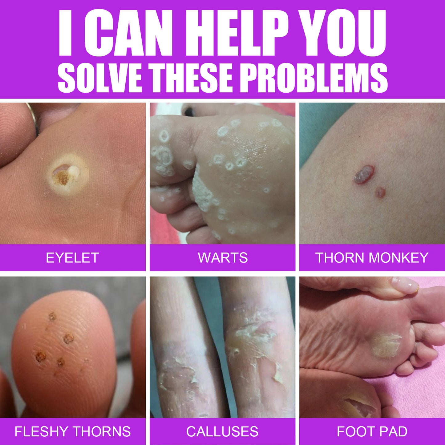 Fifuroes Remove Chicken Eye Lotion Extra Clear Remove Corns Skin Care Chicken Calluses Foot Pad Gram Warts
