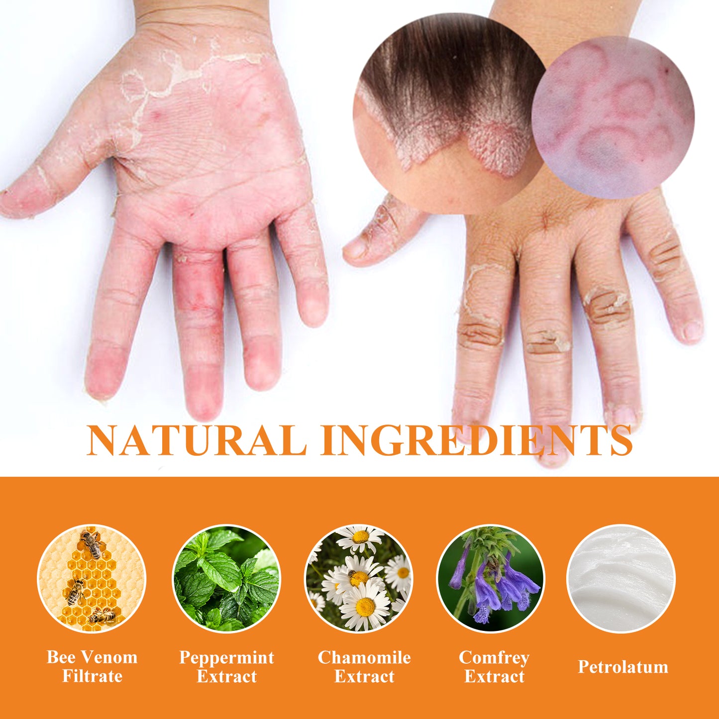 Fifuroes Bee Venom Psoriasis Cream, Relieve Itchy Skin Repair Hand Moss Moisturizing Skin Care Cream