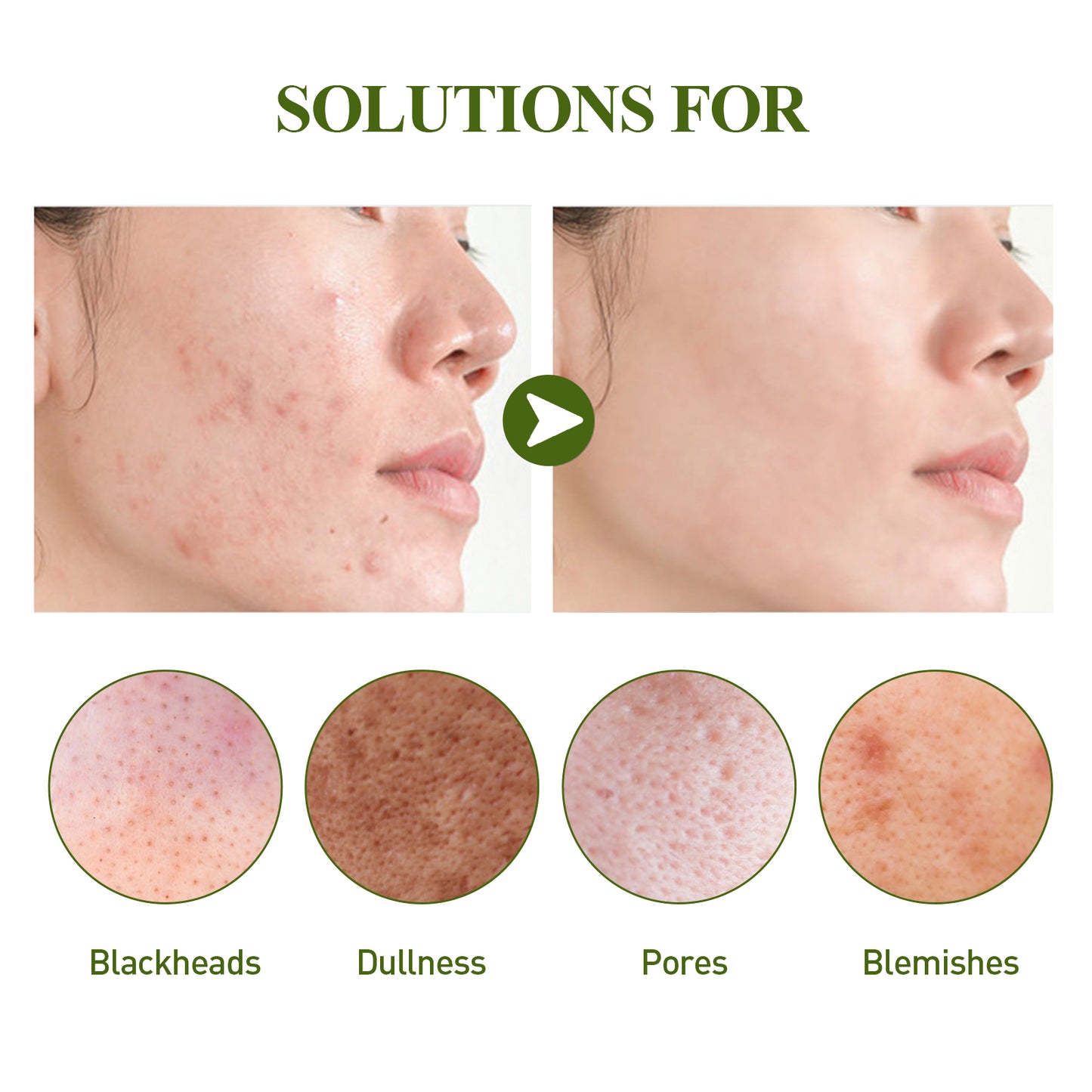 Fifuroes Blackhead Removing Serum Suit, Clean Pores Fine Oil Control Clean Repair Acne Blackhead Nose Patch